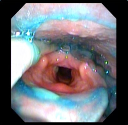 Interpretation of Flexible Endoscopic Evaluation of Swallowing (FEES) image